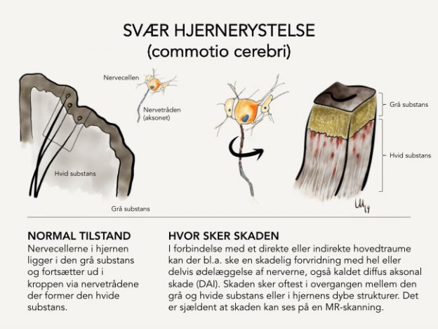 Hjernerystelse - Commotio Cerebri - Symptomer | Nortvig & Uhrenholt