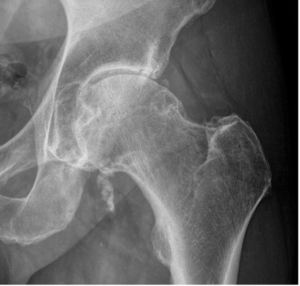 Figur viser uddrag af et røntgenbillede af venstre hofteled med slidgigt